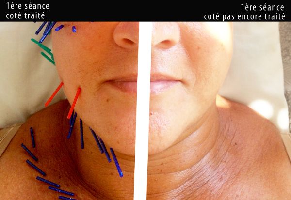 Protocole lifting par Acupuncture