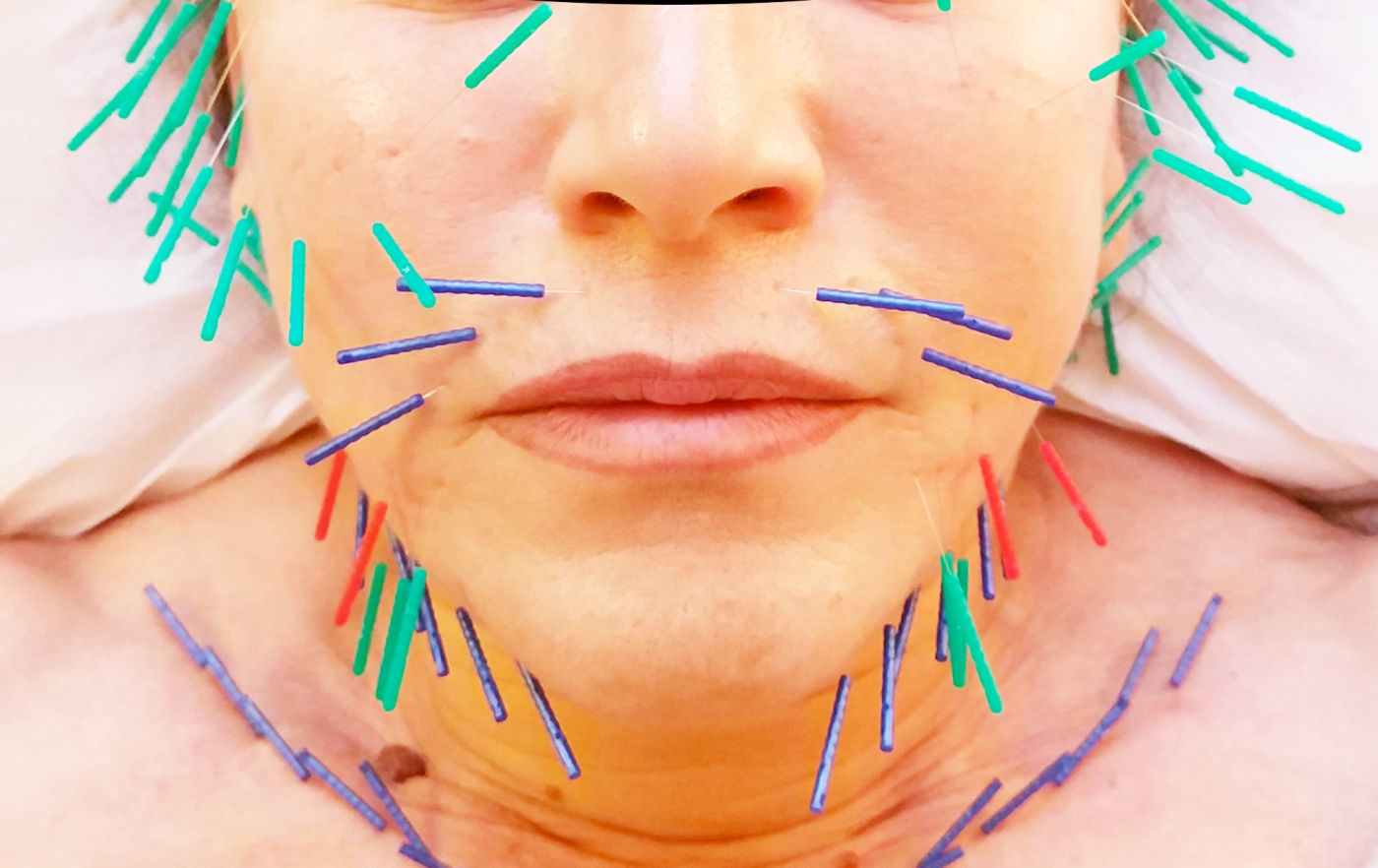 Lifting naturel acupuncture